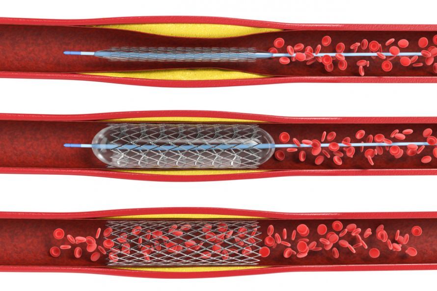 Ballondilatation mit Stent bei Arteriosklerose Διαστολή με μπαλόνι και τοποθέτηση στεντ στην αρτηριοσκλήρωση