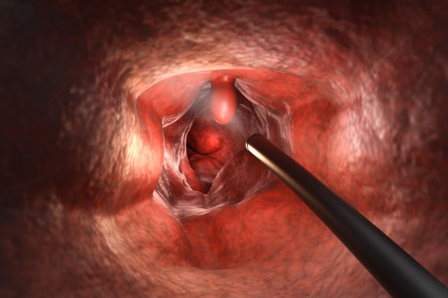 Darmspiegelung Colonoscopy