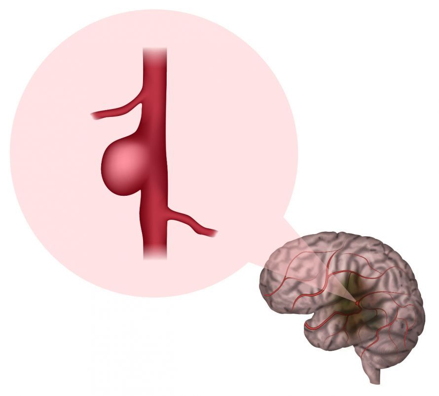 Darstellung eines Hirnaneurysmas Illustration of a brain aneurysm