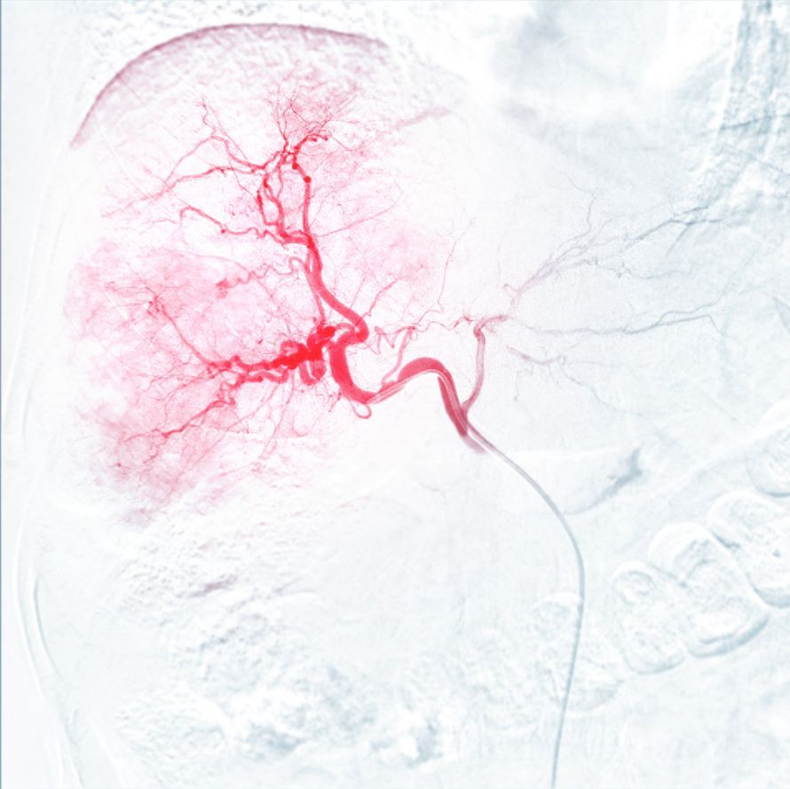 Transarterielle Chemoembolisation (TACE) Transarterielle Chemoembolisation (TACE)