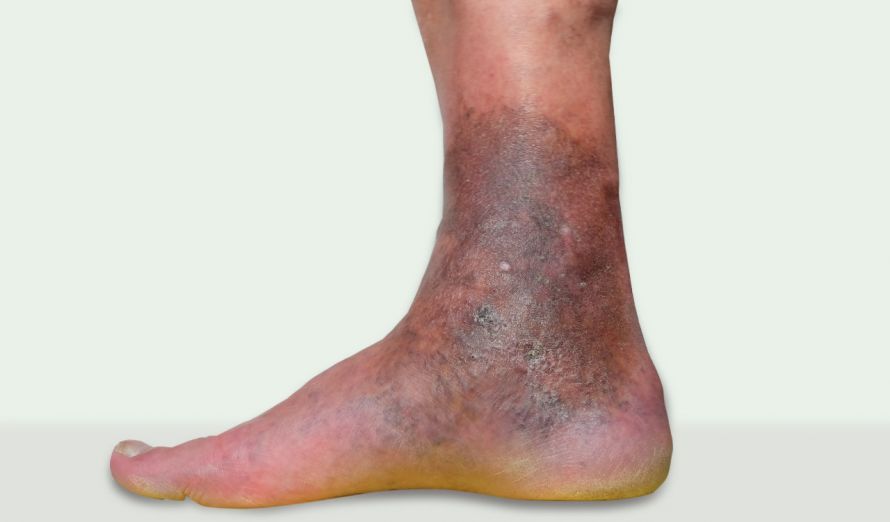 Early stage of a leg ulcer