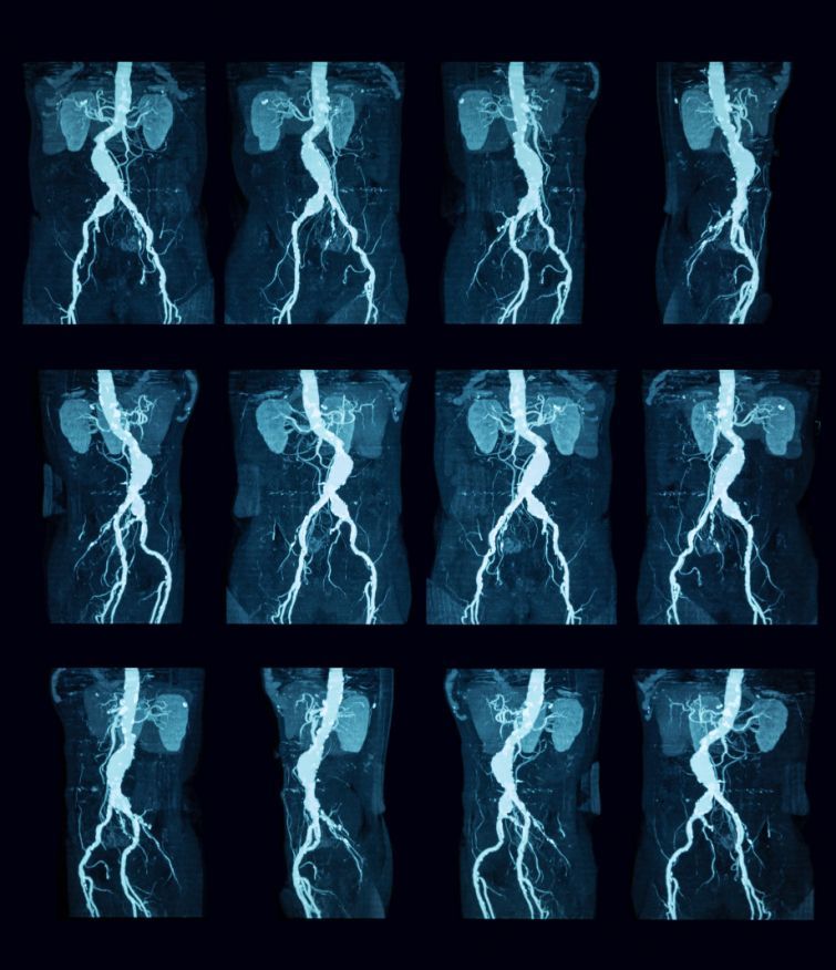 CT-Angiographie des Abdomens Αγγειογραφία κοιλίας με αξονική τομογραφία