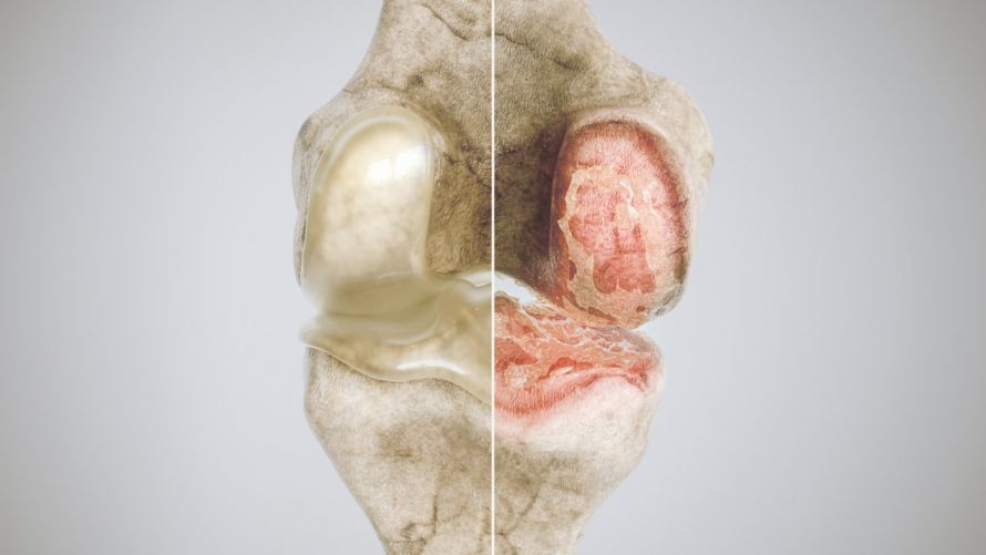 Kniearthrose Knee Osteoarthritis