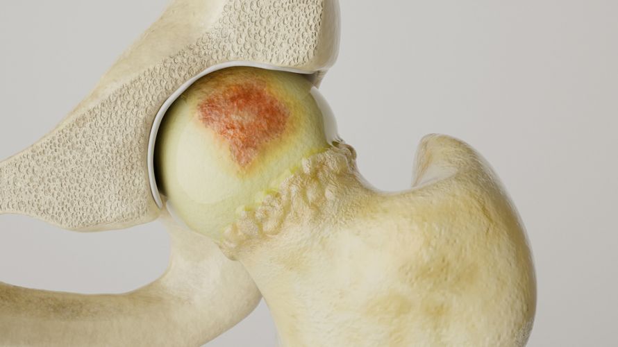 Stärkere Arthrose am Hüftgelenk