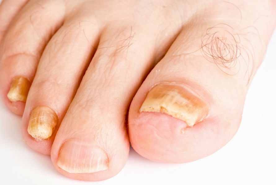 Toenail fungus on the big toe