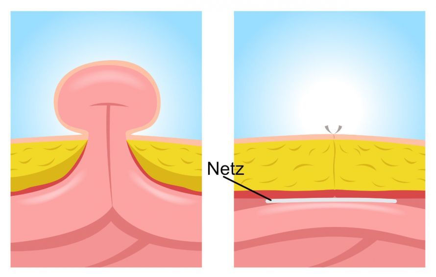 Hernientherapie mit Netzeinsatz Hernia Treatment Using a Mesh Implant