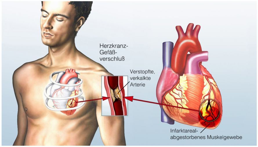 Herzinfarkt
