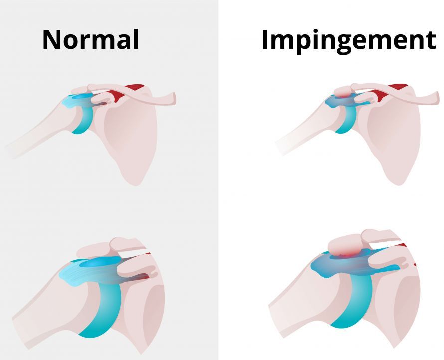 Shoulder Impingement