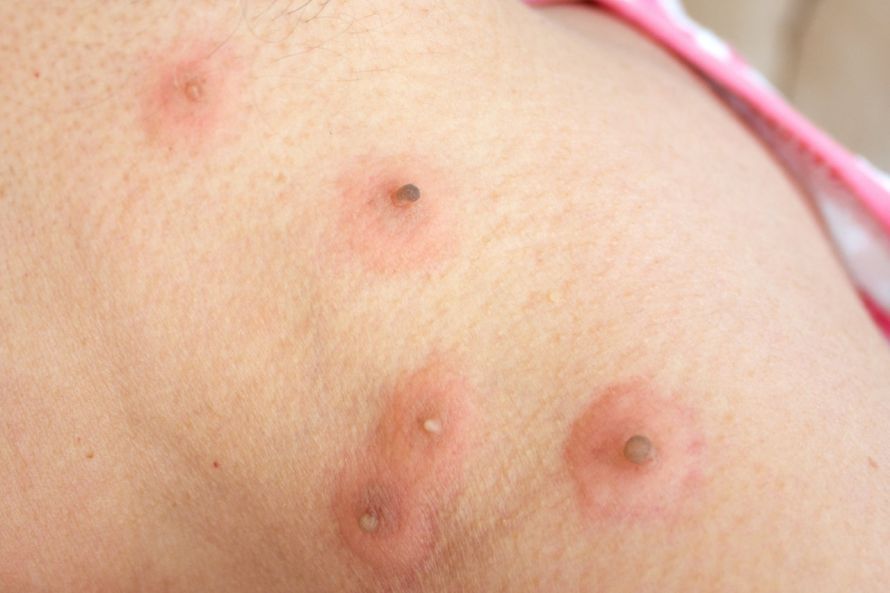 Stielwarzen nach Kryotherapie Stielwarzen nach Kryotherapie