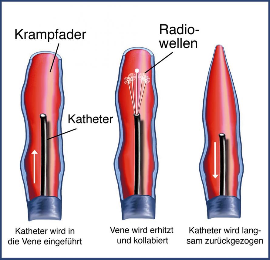 Radiowellentherapie bei Krampfadern Θεραπεία με ραδιοκύματα για τις κιρσώδεις φλέβες