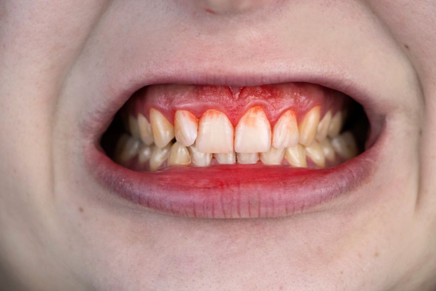 Zahnfleischentzündung Gum Inflammation
