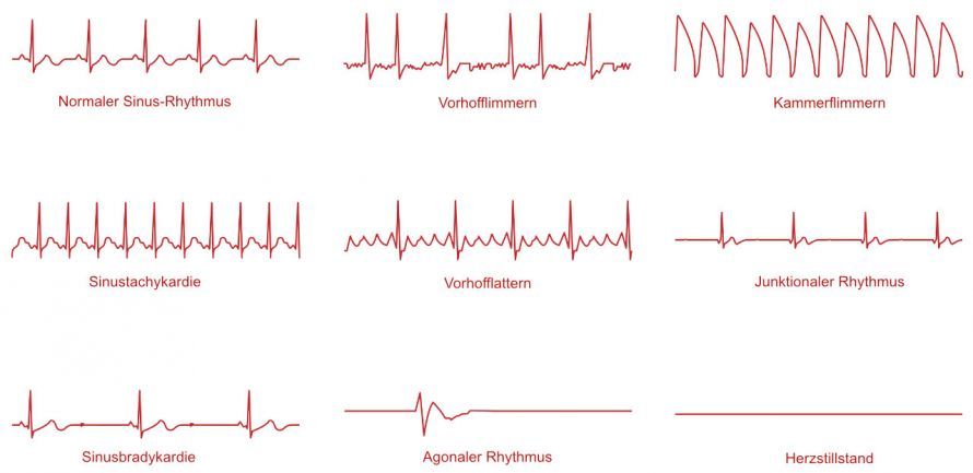 EKG-Linien und Bezeichnungen der verschiedenen Herzrhythmen Γραμμές ΗΚΓ και ονομασίες των διαφόρων καρδιακών ρυθμών