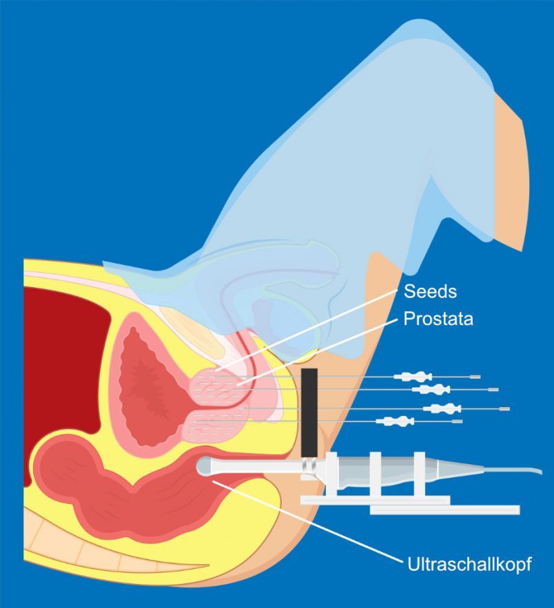 Seed-Implantation