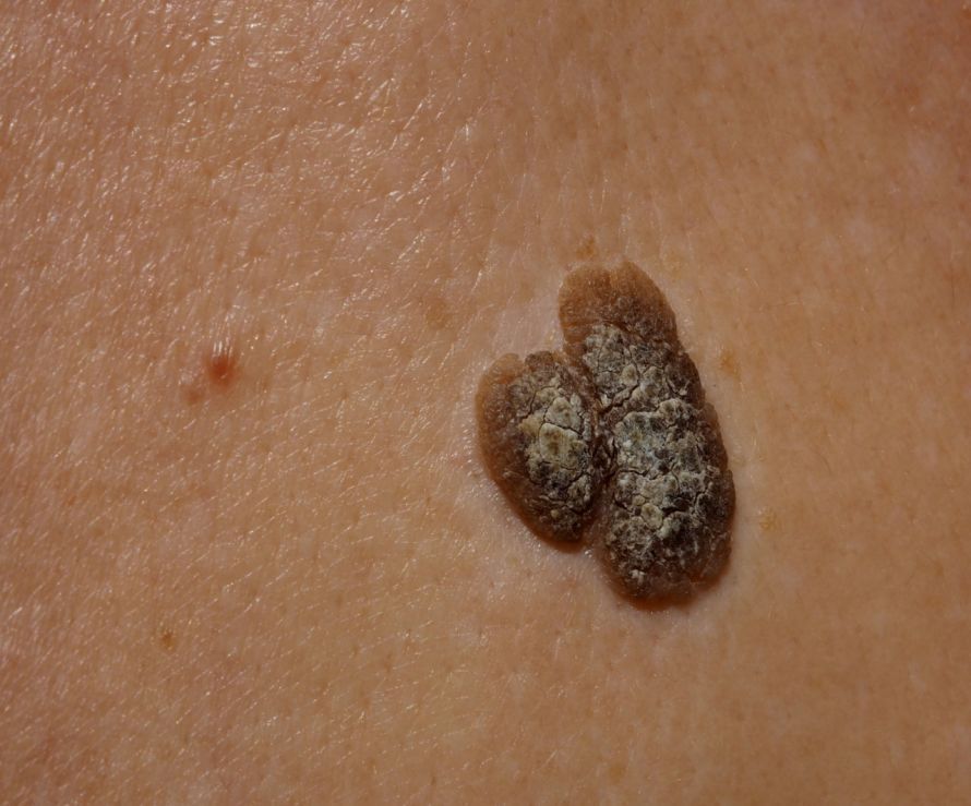 age spot