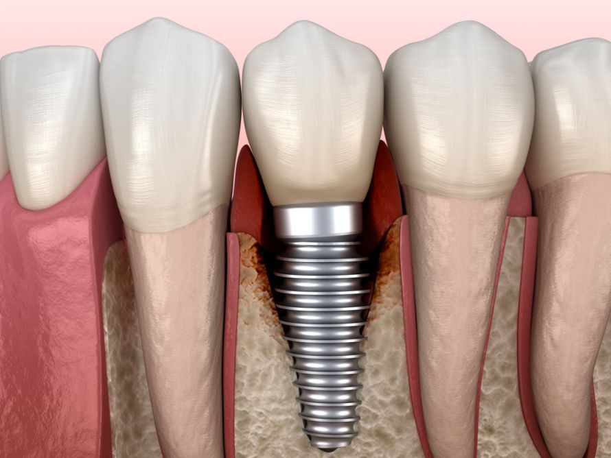 Periimplantitis (Implantatbettentzündung) Peri-implantitis (inflammation of the implant site)