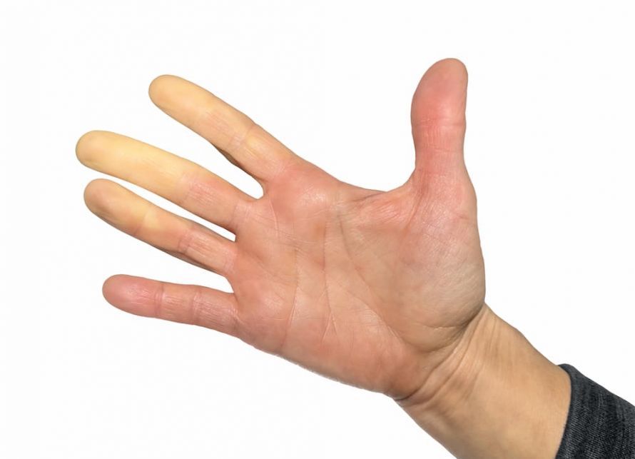 Σύνδρομο Raynaud