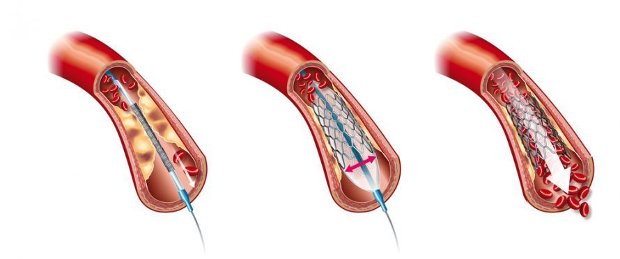 Hilfsmittel für die endovaskuläre Therapie: Ballon und Stent Hilfsmittel für die endovaskuläre Therapie: Ballon und Stent