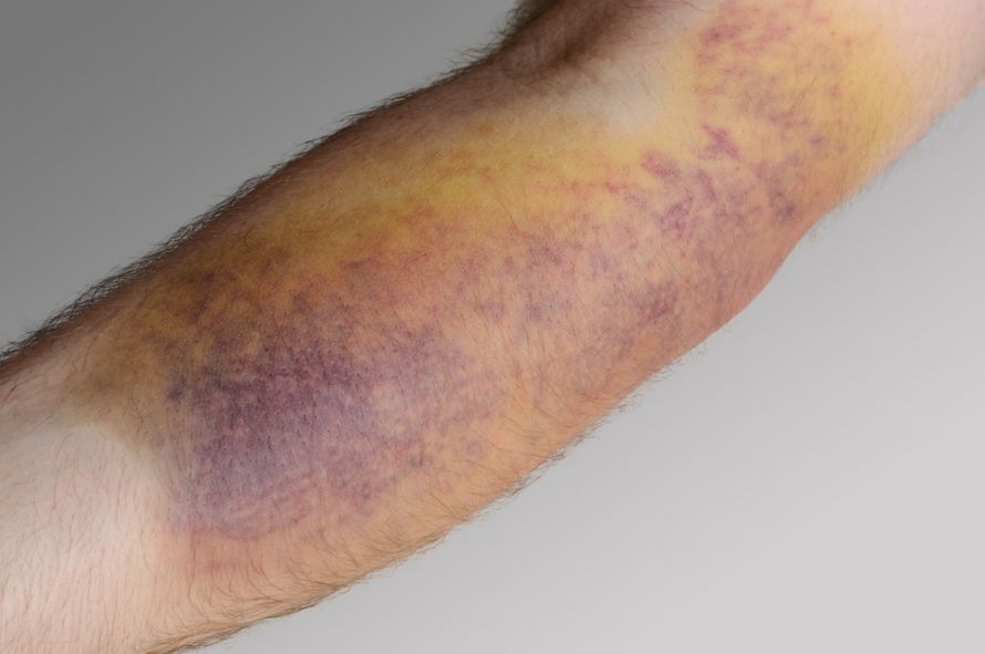 Hämatome am Arm eines Mannes