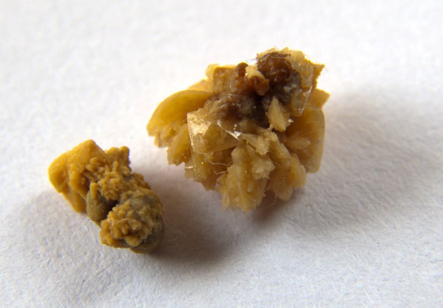 Zwei Nierensteine Two kidney stones