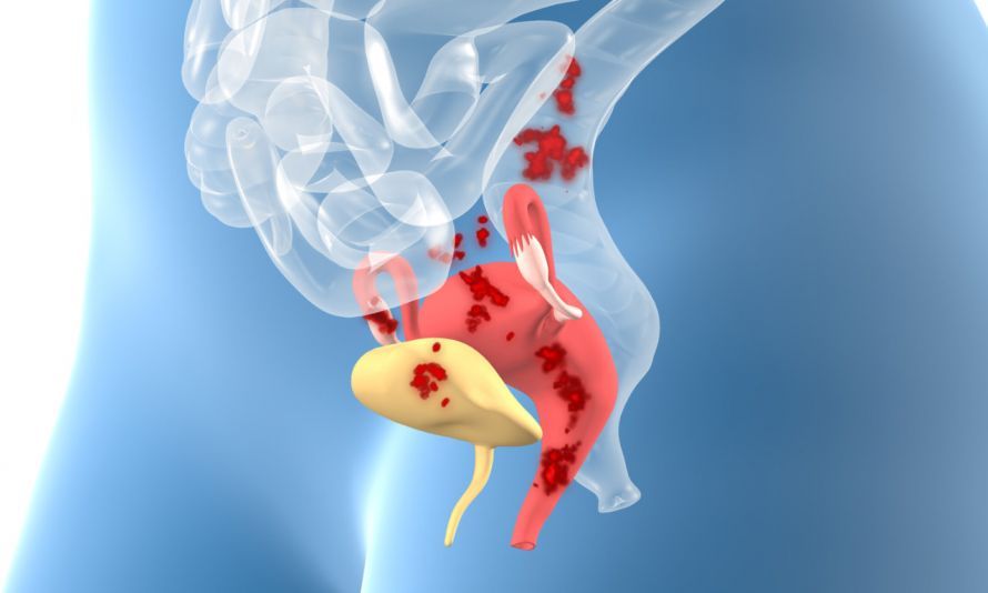 Endometriose-Herde Endometriose-Herde