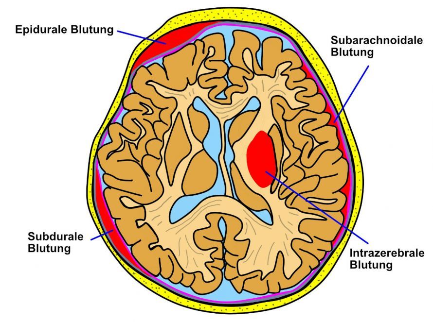 Verschiedene Formen von Hirnblutungen Verschiedene Formen von Hirnblutungen