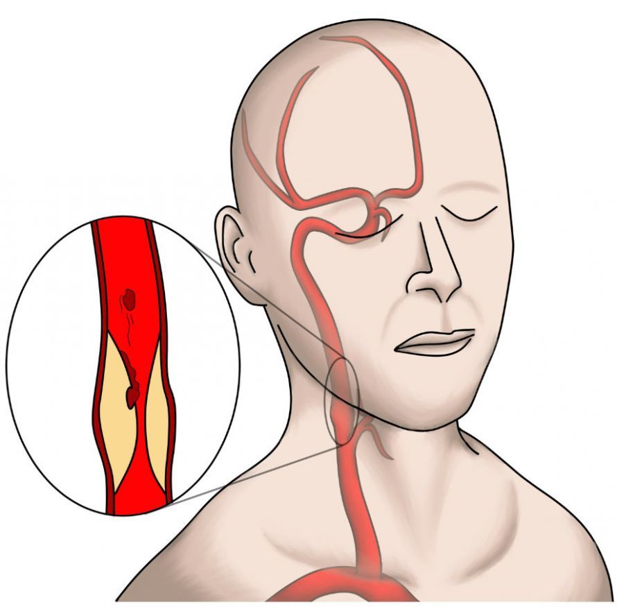 Karotisstenose Carotid Stenosis