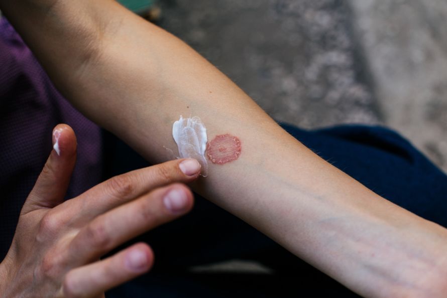 Behandlung von Pityriasis versicolor mit Creme