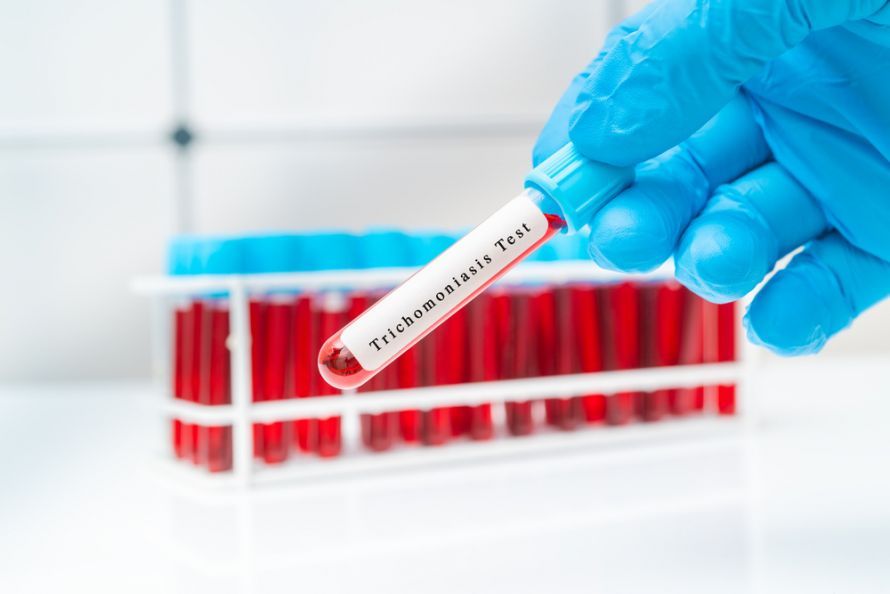 Laboratory Test for Suspected Trichomonas Infection