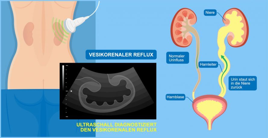 Vesikorenaler Reflux Κυστικο-νεφρική παλινδρόμηση