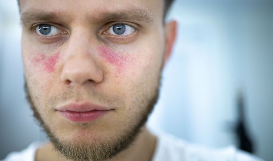 Mann mit systemischem Lupus erythematodes Άνδρας με συστηματικό ερυθηματώδη λύκο
