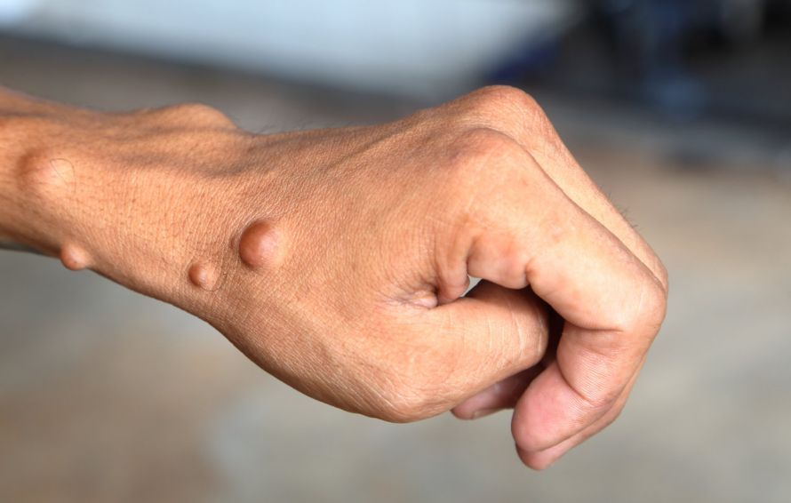 Neurofibromatose Neurofibromatose