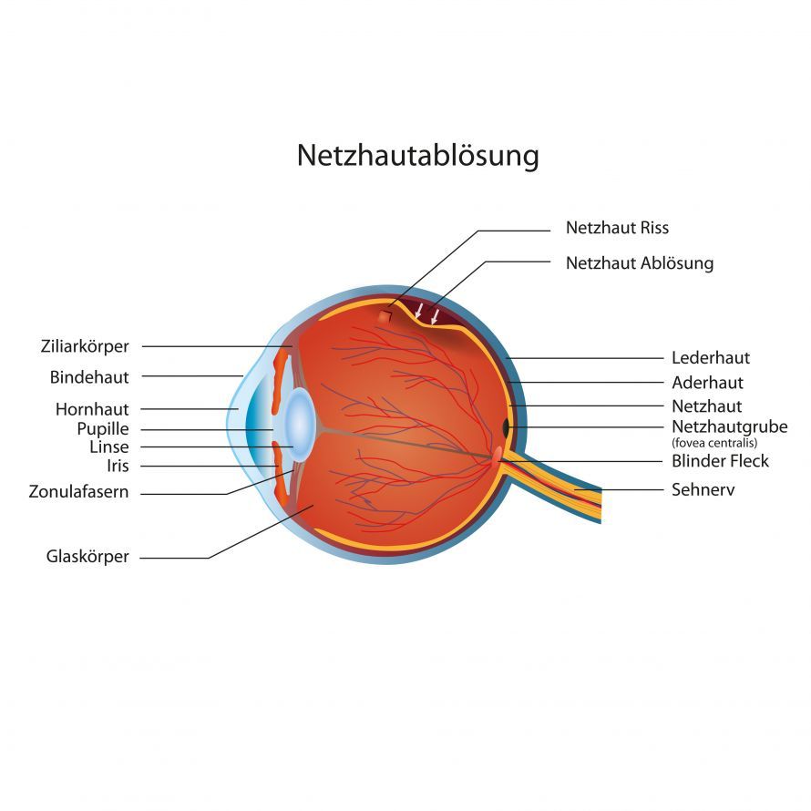 Netzhautablösung