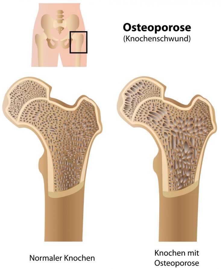 Osteoporose Οστεοπόρωση