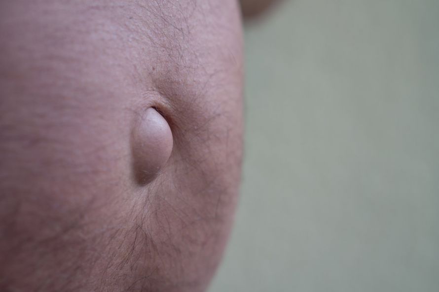 Nabelhernie bei einem Erwachsenen Nabelhernie bei einem Erwachsenen