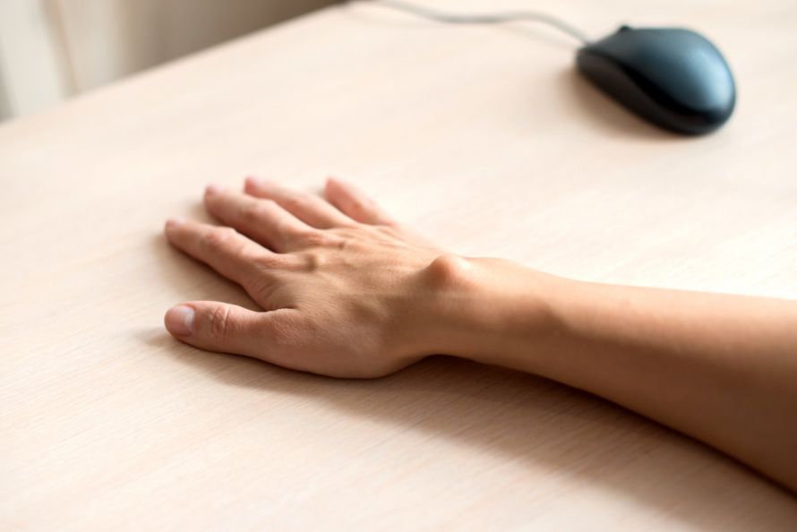 Ganglion (cyst) on the wrist