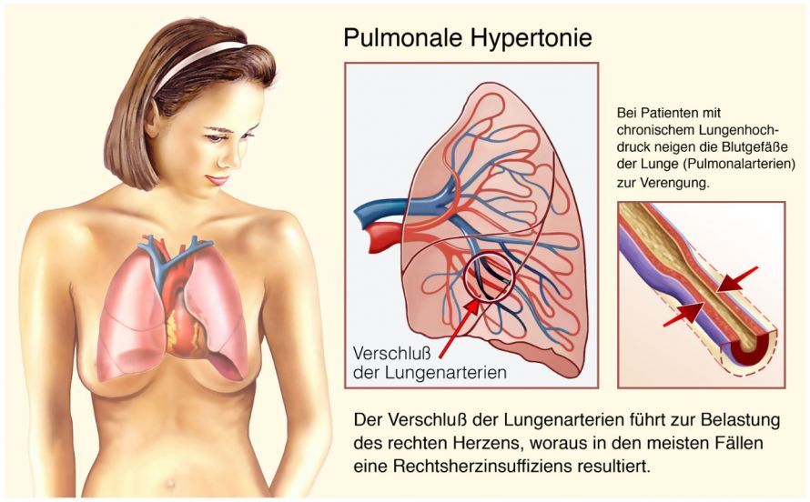 Pulmonale Hypertonie Pulmonale Hypertonie