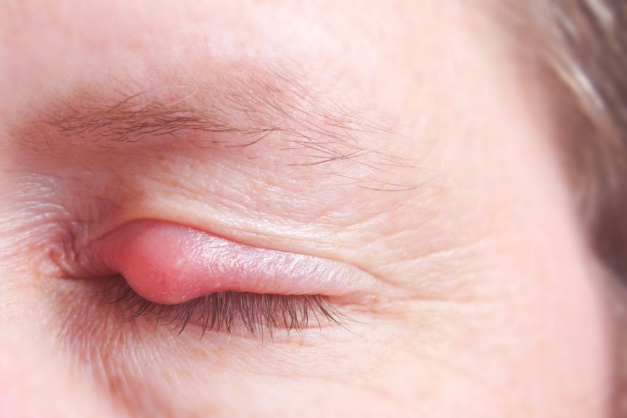 Chalazion am oberen Augenlid