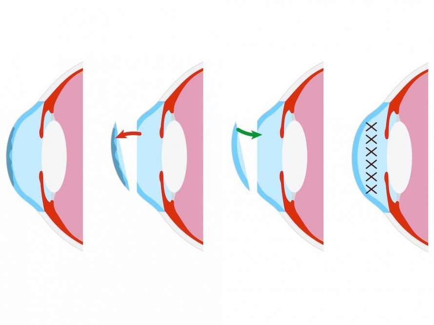 Keratoplastik