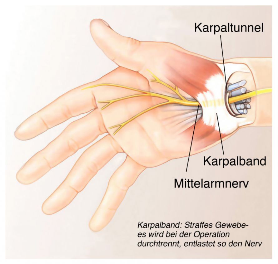 Karpaltunnelsyndrom Σύνδρομο καρπιαίου σωλήνα