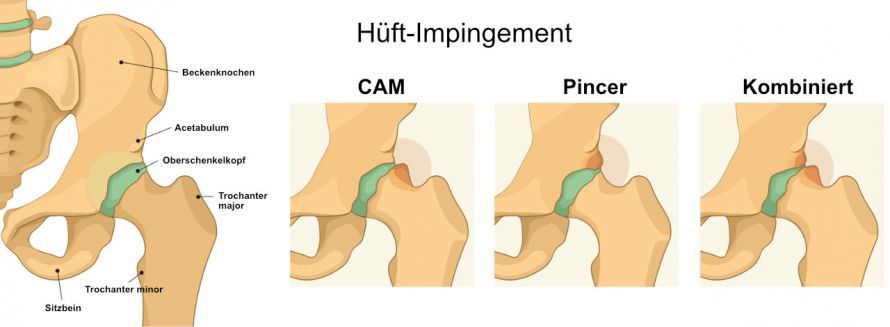 Darstellung von Hüft-Impingement-Formen Απεικόνιση των μορφών πρόσκρουσης του ισχίου