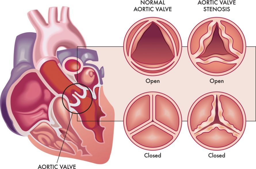 Aortenklappenstenose Aortenklappenstenose