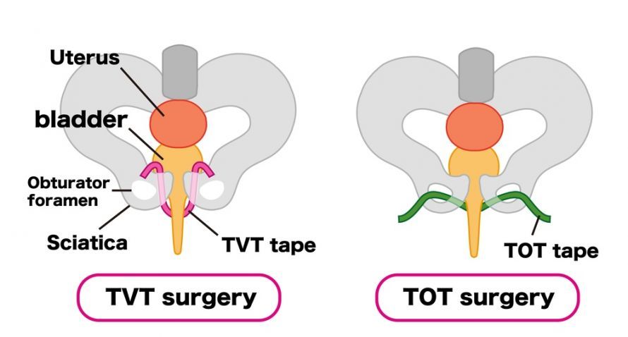TVT και TOT