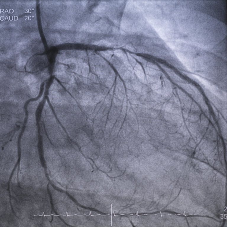 Die Angiographie kann Blutgefäße sichtbar darstellen