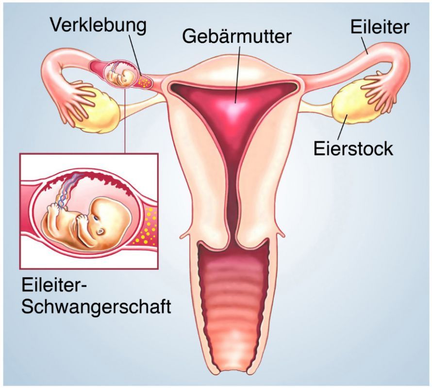 Eileiterschwangerschaft Ectopic Pregnancy