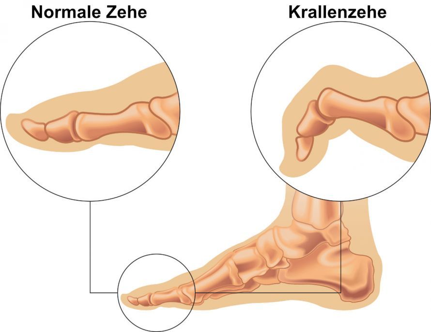 Darstellung einer Krallenzehe Darstellung einer Krallenzehe
