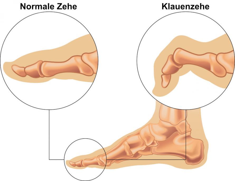 Klauenzehe Klauenzehe