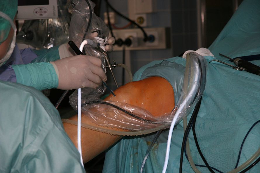 Knie-Arthroskopie