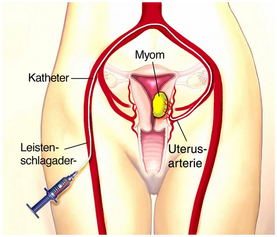 Myomembolisation