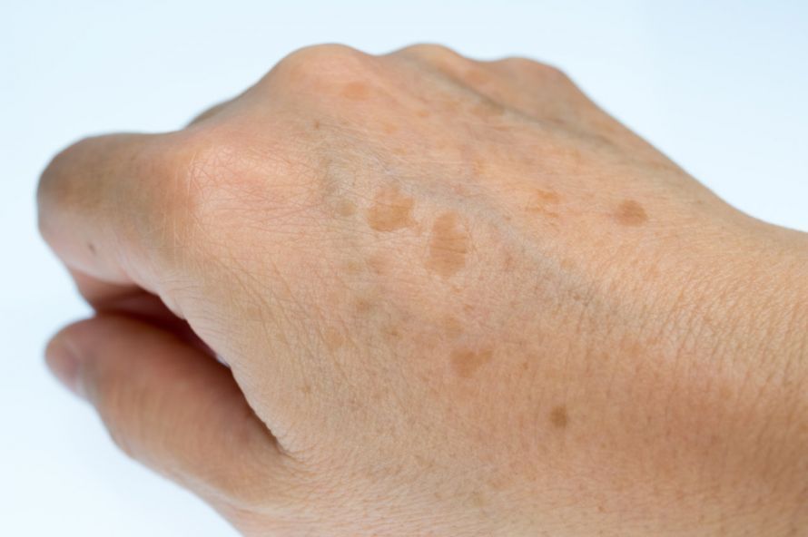 Age spots