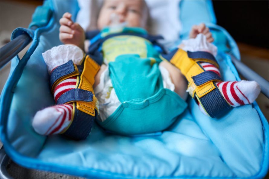 Hüftdysplasie-Behandlung eines Neugeborenen mit Schienen Hüftdysplasie-Behandlung eines Neugeborenen mit Schienen